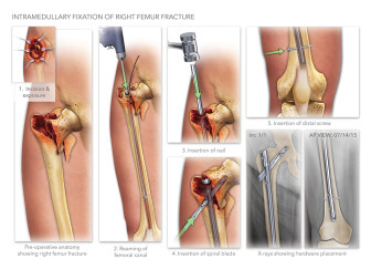 Intramedullary Fixation of Right Femur Fracture