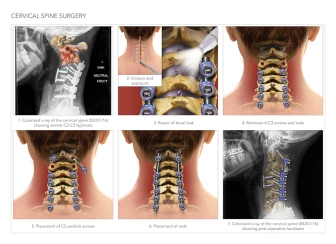 Cervical Spine Surgery Illustration