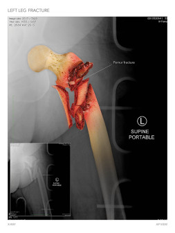Left Leg Fracture