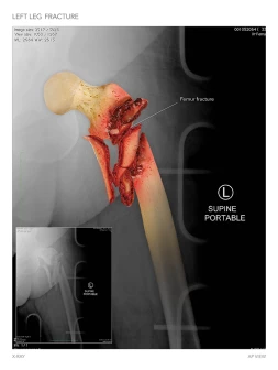 Left Leg Fracture