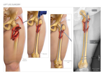 Intramedullary Nailing of Femur Fracture