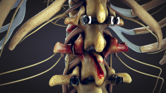 T11-L4 Posterior Spinal Fusion