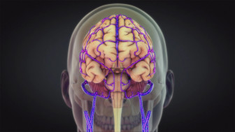 Mastoiditis Causing Infected Blood Clot