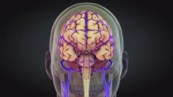 Mastoiditis Causing Infected Blood Clot