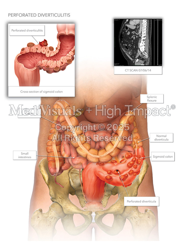 Perforated Diverticulitis