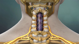 $3.1M Verdict: Animating Spinal Cord Injury After Premature Discharge from Hospital
