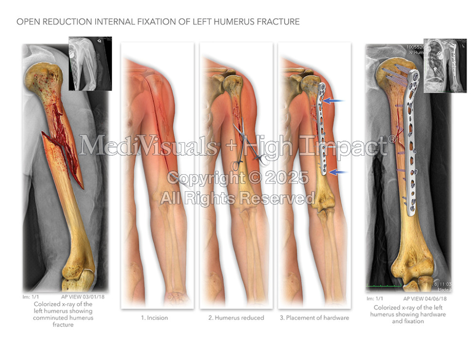 Open Reduction Internal Fixation of Left Humerus Fracture