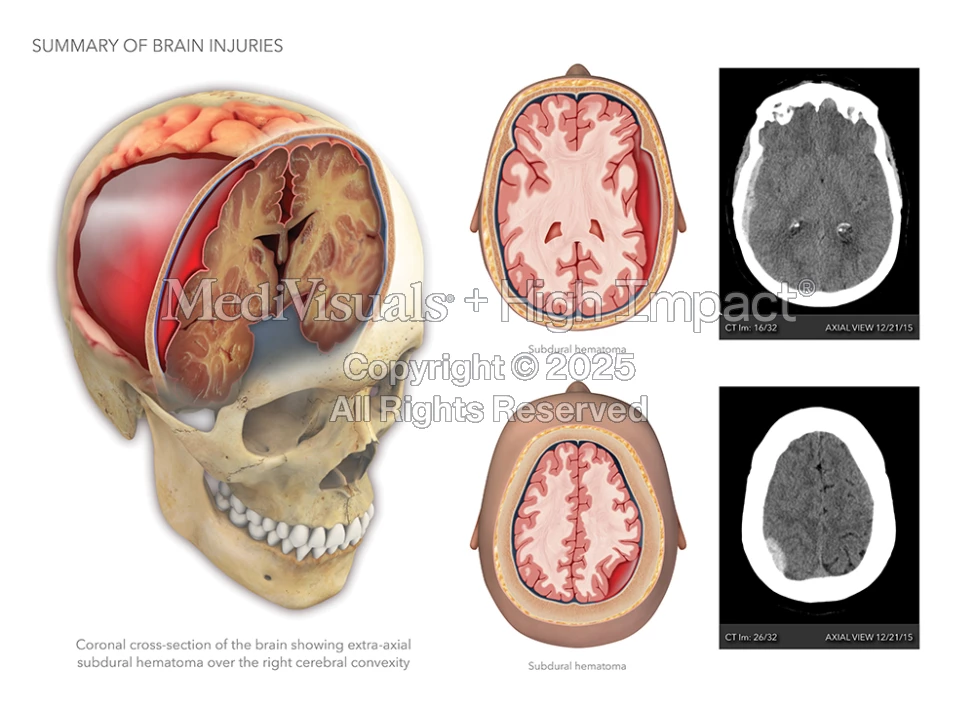 Summary of Brain Injuries