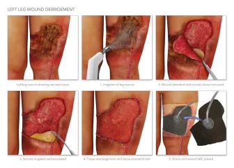 Left Leg Wound Debridement