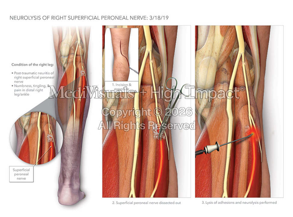 Neurolysis of the Superficial Peroneal Nerve