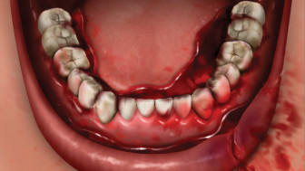 $1M Settlement: Illustrating Fractured Jaw After Cyclist Hit by Truck