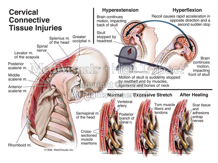 Cervical Connective Tissue Injuries