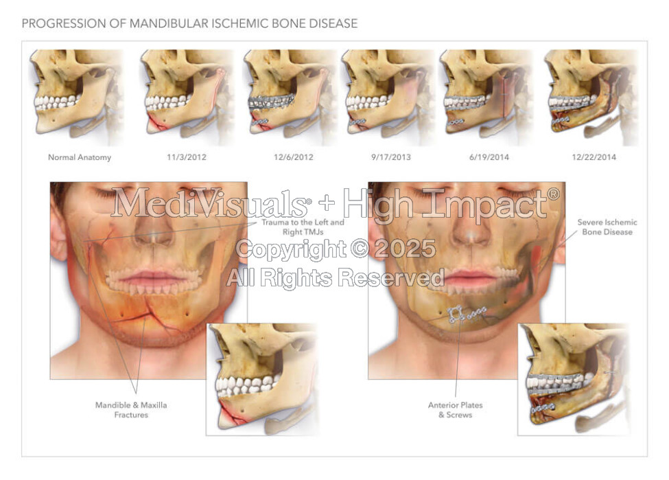 Mandibular Ischemic Bone Disease