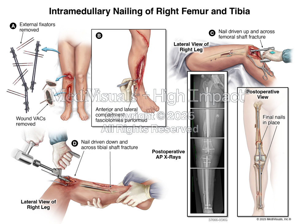 $3.5M Verdict: Traumatic Leg Injuries Following Motor Vehicle Collision