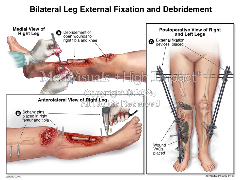 $3.5M Verdict: Traumatic Leg Injuries Following Motor Vehicle Collision