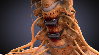 C4–6 Disc Replacement