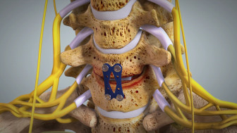 Anterior Cervical Discectomy with Fusion