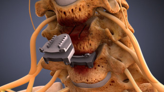 $2.25M Settlement on $8,700 Offer: Animating Cervical Disc Replacement