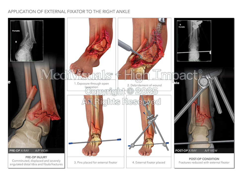 $2.4M Verdict: Illustrating Ankle Fractures After Drunk Driving Crash