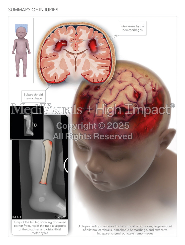 $2.75M Settlement: Illustrating Premature Baby’s Brain Injury After High-Speed Collision