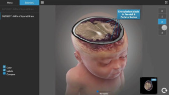 Hypoxic Ischemic Injuries