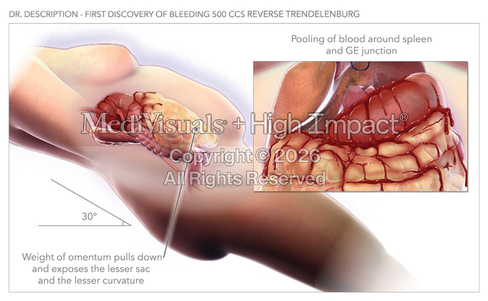 $10 Million Settlement: Brain Damage During Bariatric Surgery