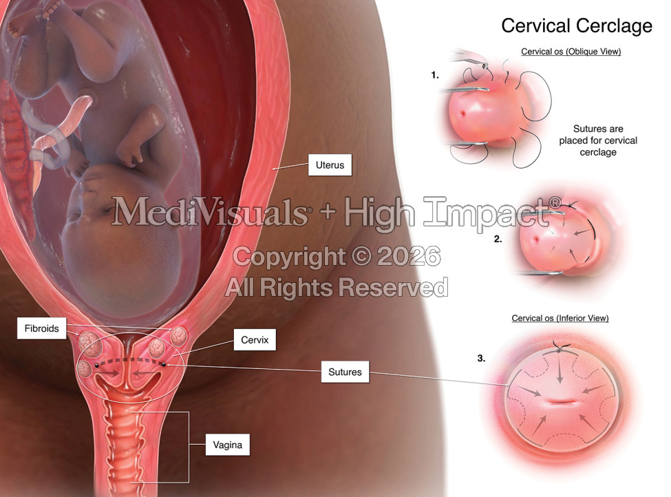 Medical Illustrations Help Secure $14 Million Verdict in Birth Injury Malpractice Case