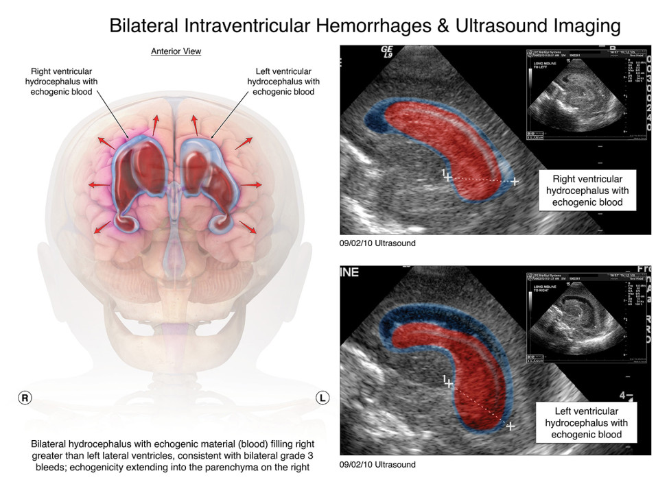 Medical Illustrations Help Secure $14 Million Verdict in Birth Injury Malpractice Case