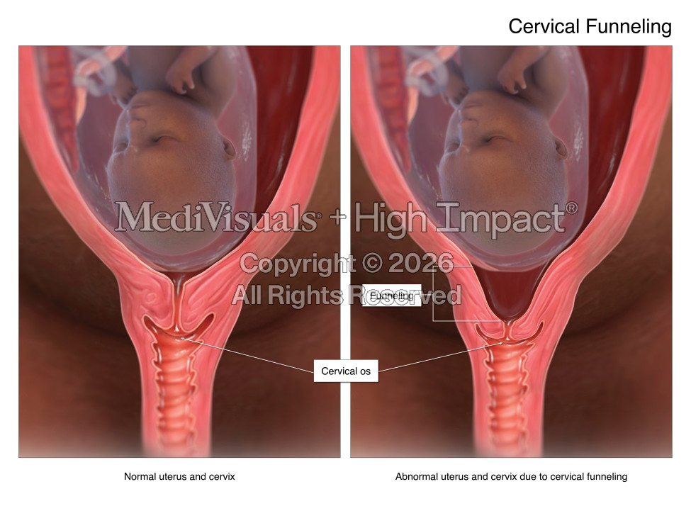 Medical Illustrations Help Secure $14 Million Verdict in Birth Injury Malpractice Case