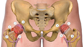 $4M Verdict: Medication Error Leads to Severe Hip Injuries