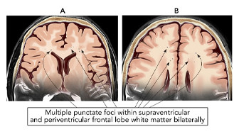 $5.65 Million Verdict in a Challenging, Non-Specific Brain Injury Case