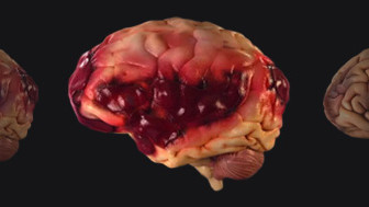 $5M Settlement: 3D Animated TBI Timeline Charts Progression of Encephalomalacia