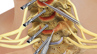 $31M Verdict: Improperly Maintained Parking Lot