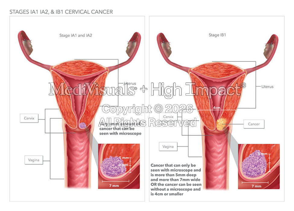 Stages of Cervical Cancer