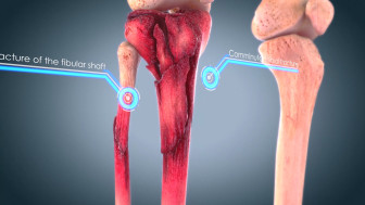 Summary of Orthopedic Injuries and Repair