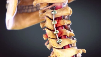 Cervical Spine Fractures and Fixation