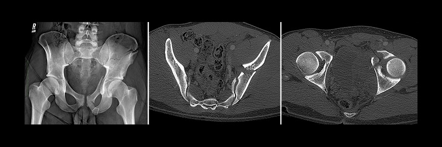 $1.75M Verdict: Colorized Films Highlight Motorcycle Injuries
