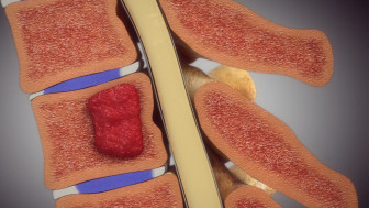 $4.825M Settlement: CSI Animation Reveals Spine Injury and Surgical Fusion