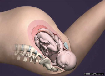 Shoulder Dystocia without Brachial Plexus Injury