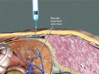 Thoracostomy – Improper