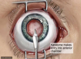 Intraocular Lens Implant