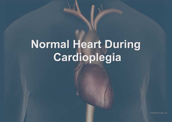 Normal heart During Cardioplegia