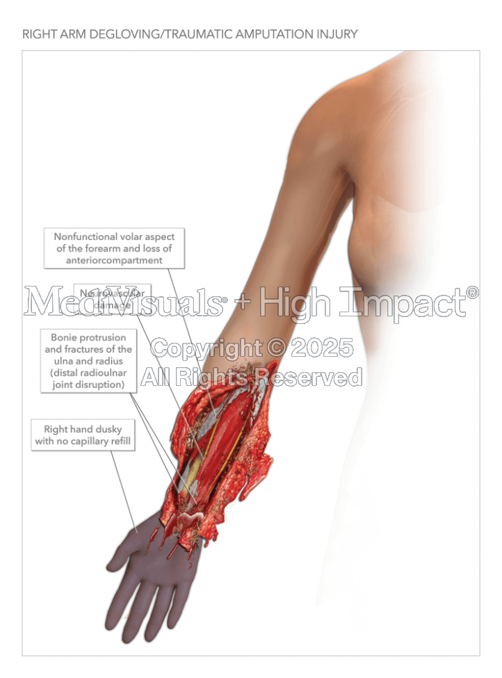 Degloving & Amputation