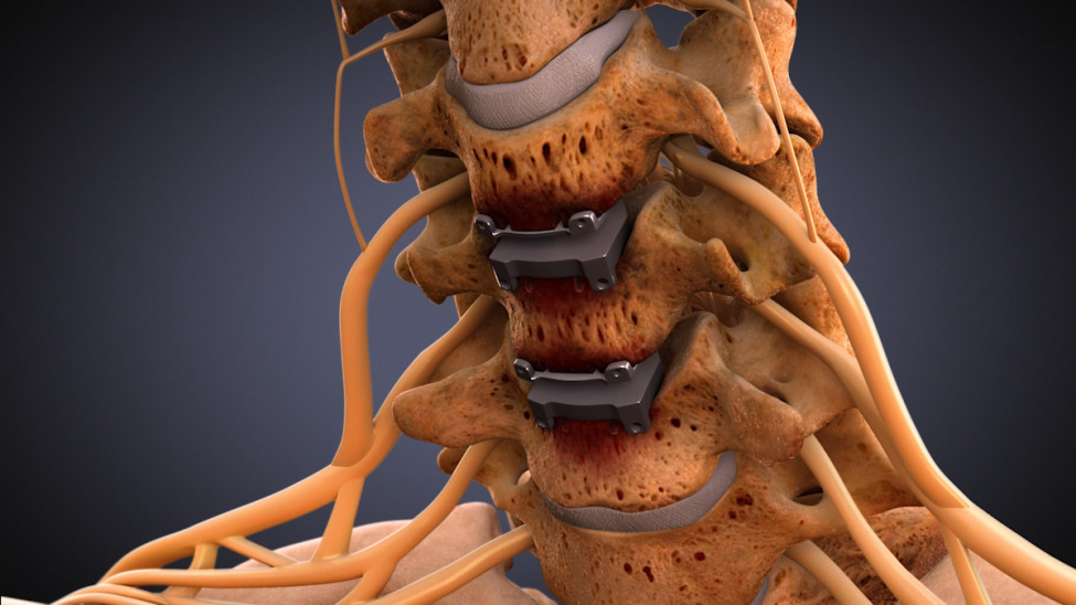 $2.25M Settlement on $8,700 Offer: Animating Cervical Disc Replacement