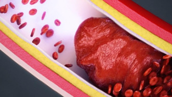 Medical Animation Depicts How Stroke Caused “Locked-In” Syndrome, $75M Verdict Awarded