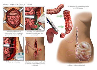 Bowel Perforation and Repair