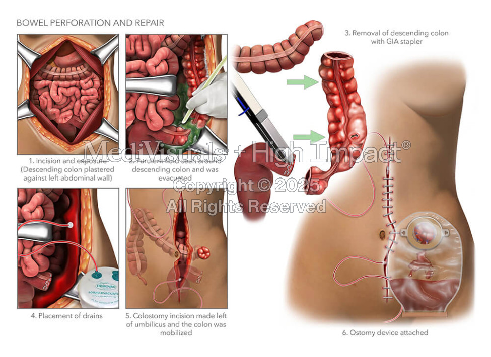Bowel Perforation and Repair