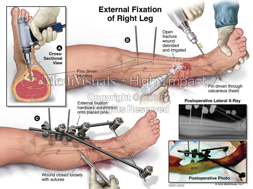 External Fixation of Right Leg