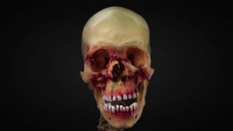 Summary of Facial Fractures and Repair