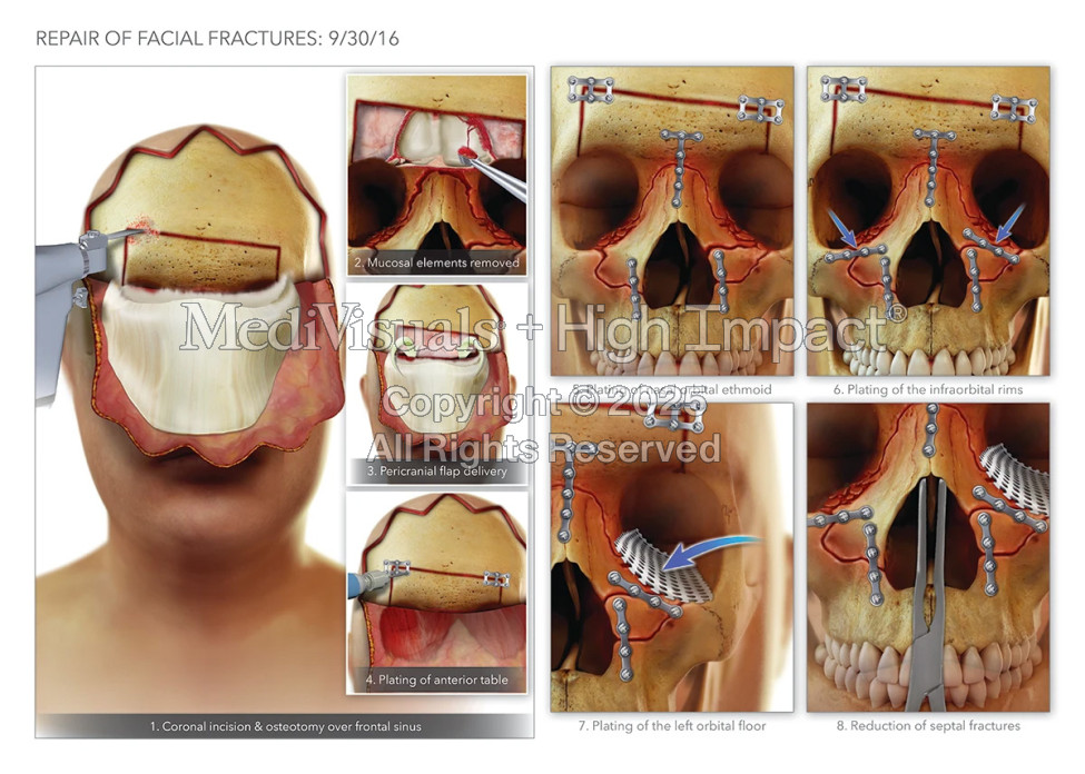 $825K Settlement: Illustrating Facial Fractures, Surgery After Tire Explosion